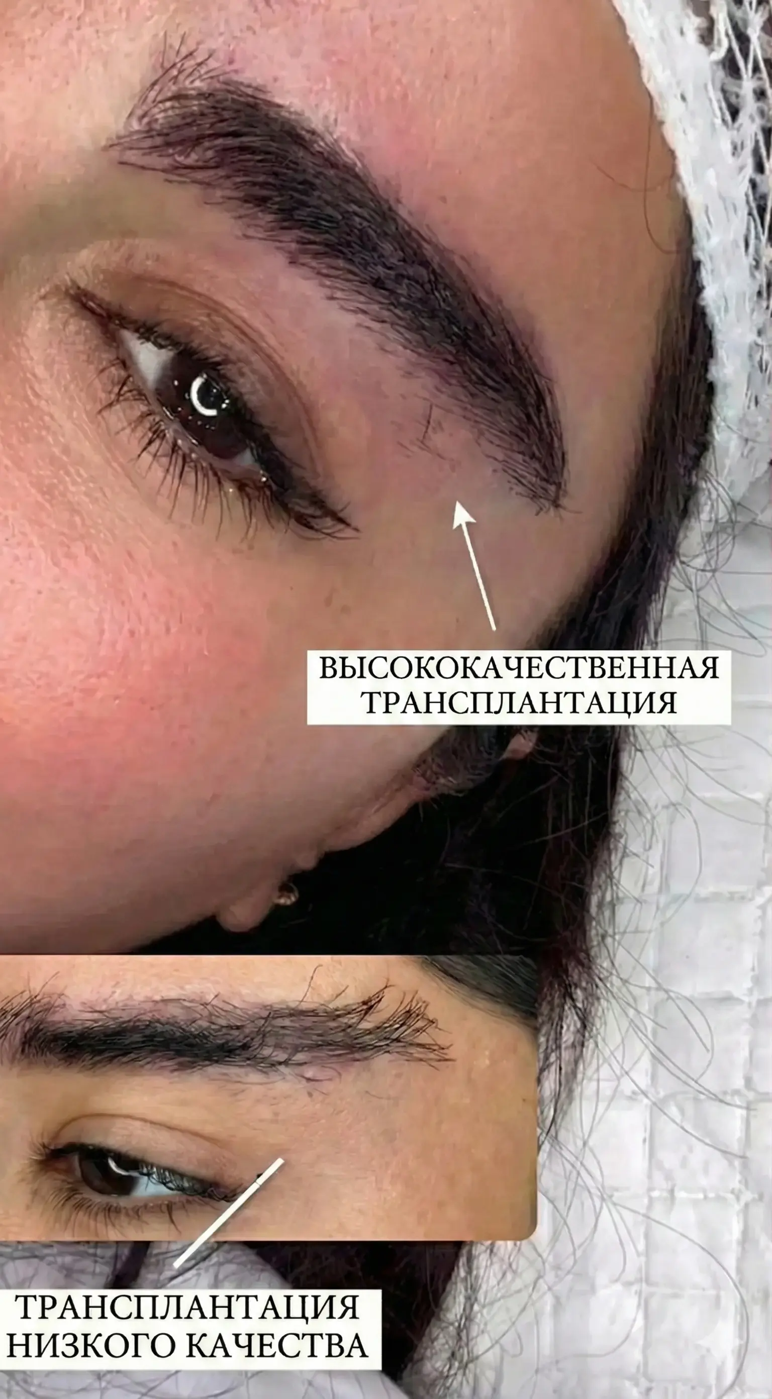 Comparison between FUE and AF transplant methods